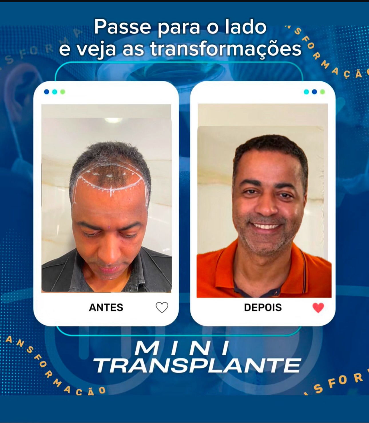 Transformação MINI Transplante Capilar 1