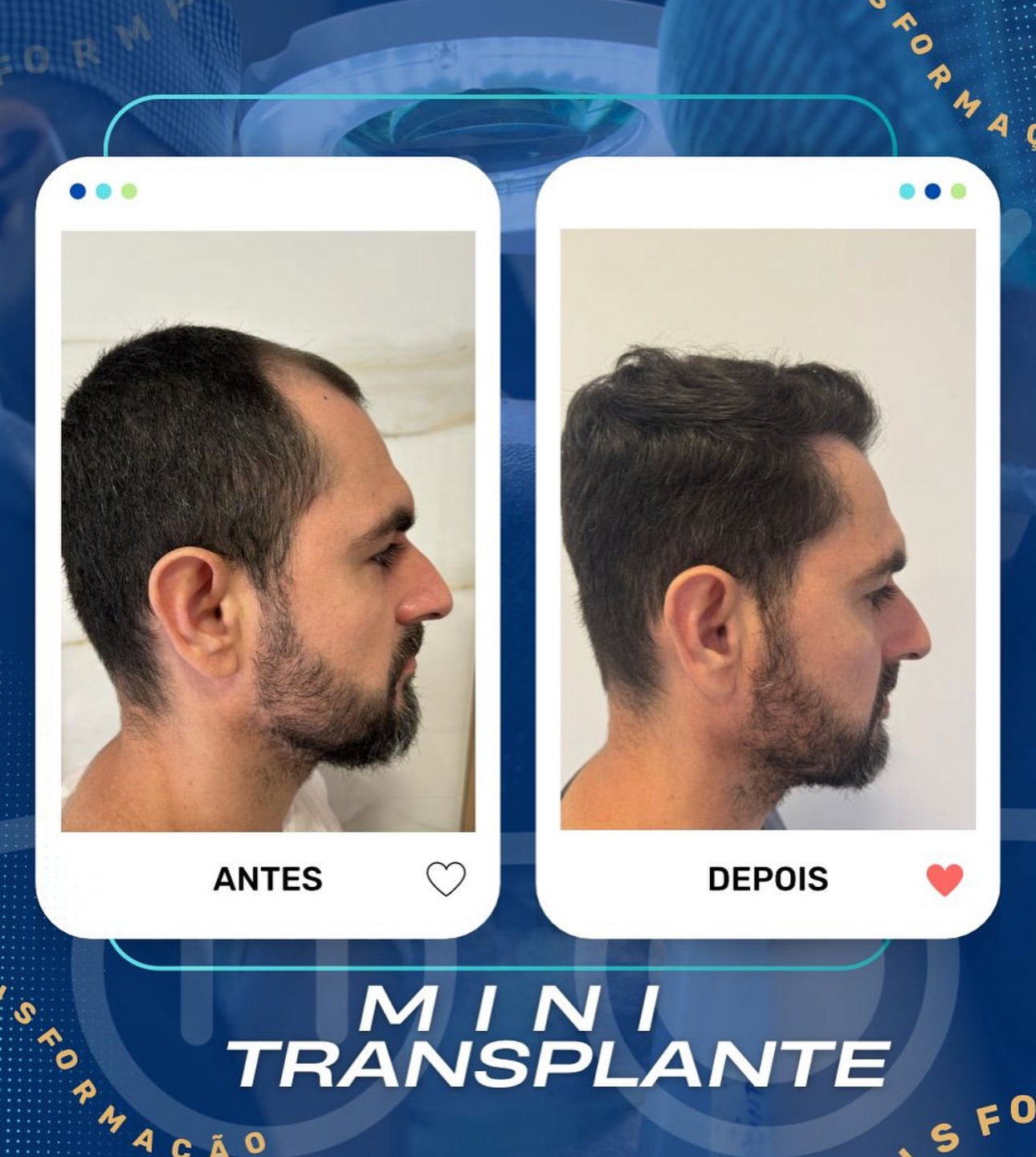 Transformação MINI Transplante Capilar 2